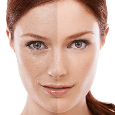 Is Fractional CO2 Laser Treatment Painful?