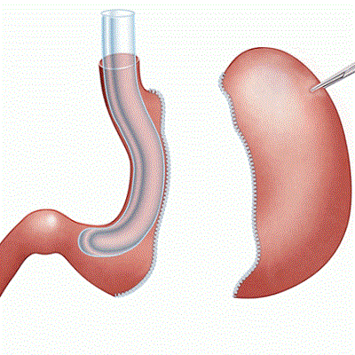 Is Gastric Sleeve A High-Risk Surgery in Dubai