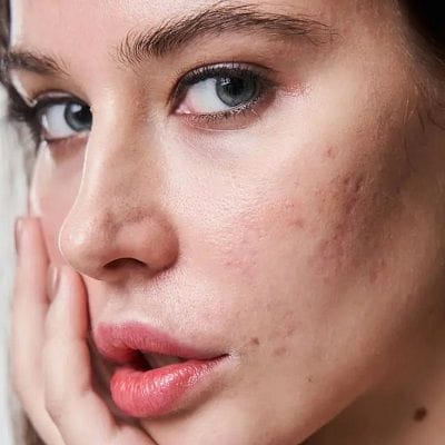 Is Microneedling Good for Acne Scarring? 1 Is Microneedling Good for Acne Scarring?