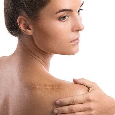 Is There a Way to Permanently Remove Keloids? 1 Is There a Way to Permanently Remove Keloids?