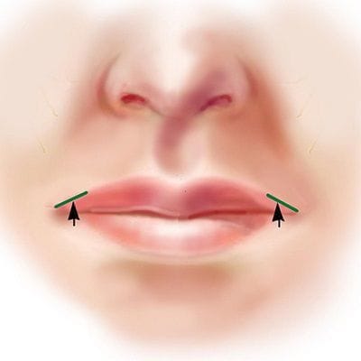 Italian Lip Lift in Dubai, Abu Dhabi & Sharjah | Prices and Deals