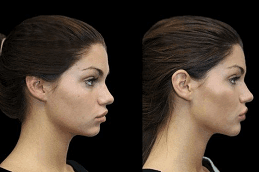 Jawline Contouring Before and After