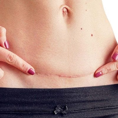 The Most Extra Ordinary Keloid Scar Removal Methods