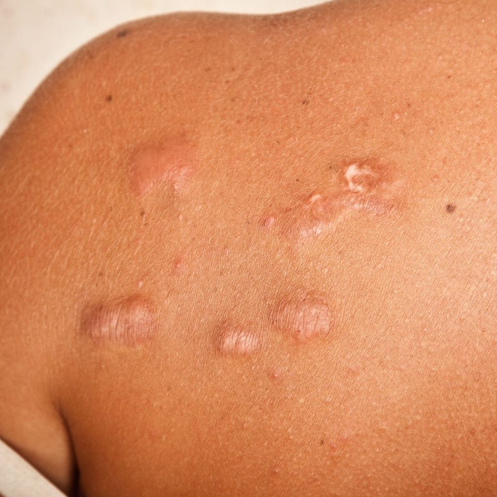 Keloid Treatment for Black Skin