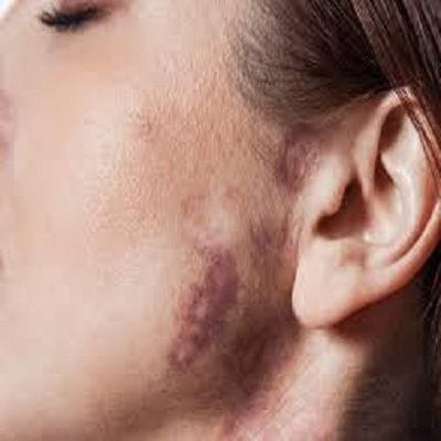 Laser Birthmark Removal Cost in Dubai 1 Laser Birthmark Removal Cost in Dubai