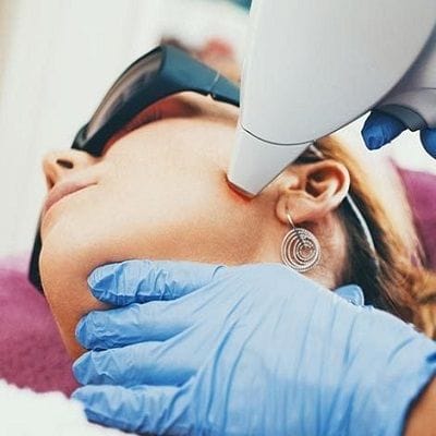Laser Hair Removal for Women with PCOS