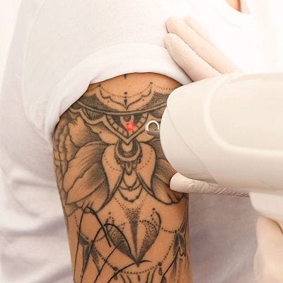 Laser Tattoo Removal in Nad Al Sheba