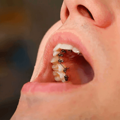 Lingual Braces in Dubai