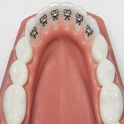 Lingual braces in dubai