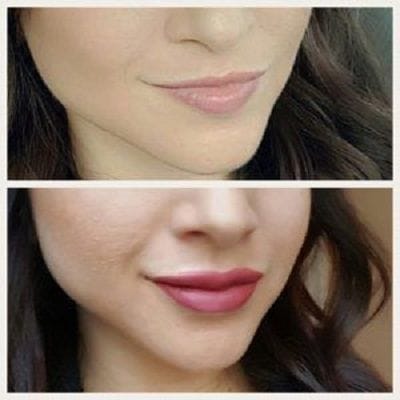 Lip Augmentation in Dubai