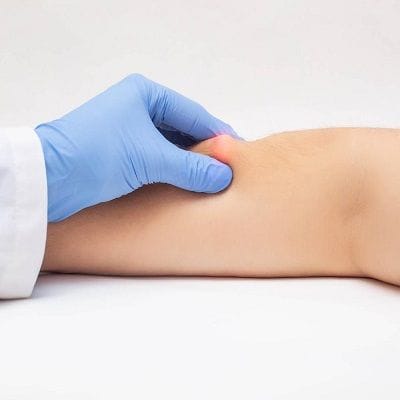 Lipoma Removal Cost in Dubai 1 Lipoma Removal Cost in Dubai, Abu Dhabi & Sharjah | Lipoma Treatment Cost
