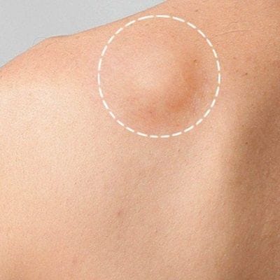 Lipoma Treatment Cost in Dubai 1 Lipoma Treatment Cost in Dubai