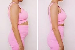 Liposuction Before & After