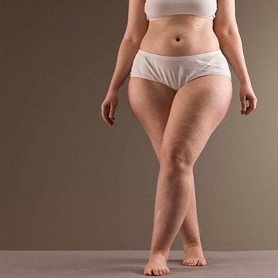 Liposuction For Lipedema Cost