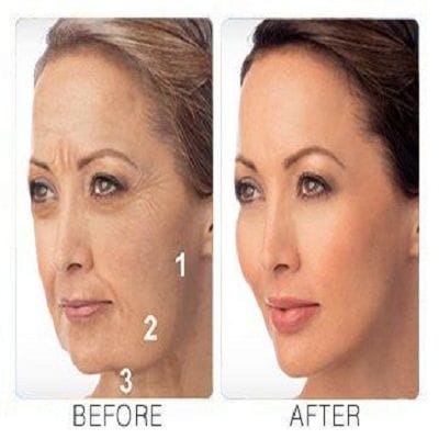 Liquid Facelift in Dubai