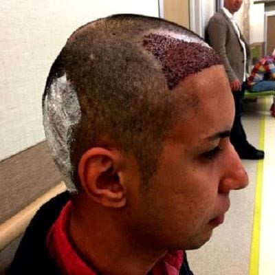 Turkish Hair Transplant 1 Turkish Hair Transplant