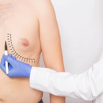 Gynecomastia Alert! Do's and Don'ts Before Male Breast Reduction Surgery 1 Male Breast Reduction Surgery in Dubai -The Do's and Don'ts