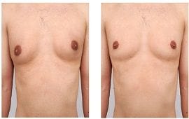 Best Breast Reduction Clinic Dubai 10 Male breast reduction surgery in Dubai