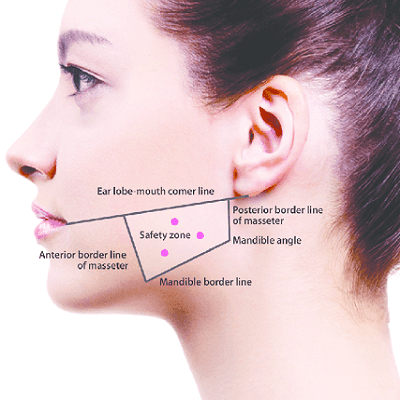 Masseter Botox Injection Treatment