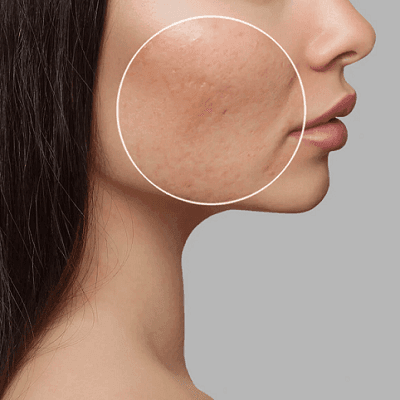 Microneedling and Acne Scars: Can It Help Reduce Their Appearance? 1 Microneedling and Acne Scars Can It Help Reduce Their Appearance