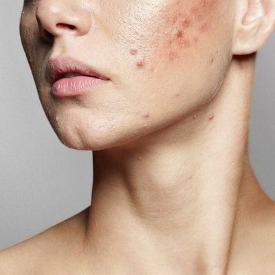Minimize Acne Scars And Boost Confidence 1 Minimize Acne Scars And Boost Confidence