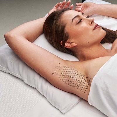 MiraDry for Excessive Underarm Sweating