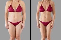 Mommy Makeover 4 Mommy Makeover in Dubai Before & After