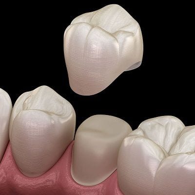 Most Common Types of Dental Crowns in Dubai