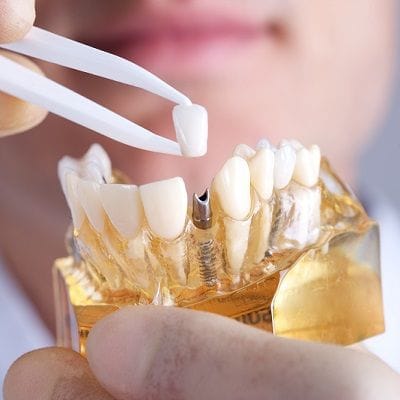 Myths About Dental Implants 1 Myths About Dental Implants