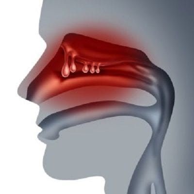 Nasal Polyps & Sinusitis Surgery in Dubai & Abu Dhabi