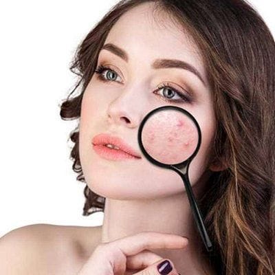 Natural Remedies for Pimples in Dubai