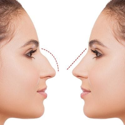 Non-Invasive Rhinoplasty Cost