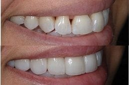 Non-Prep Veneers in Abu Dhabi