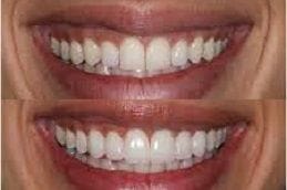 Non-Prep Veneers in Dubai