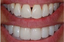 Non-Prep Veneers
