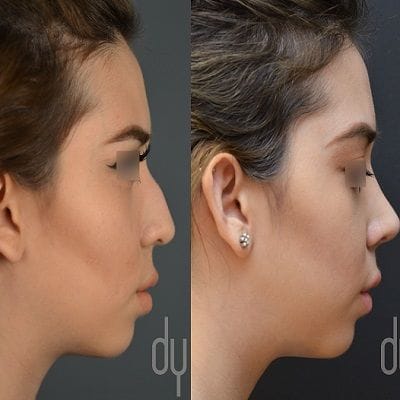 Nose Surgery with Hollywood Surgeon in Dubai 1 Nose Surgery With Hollywood Surgeon in Dubai