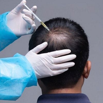 PRP Injection for Black Hair