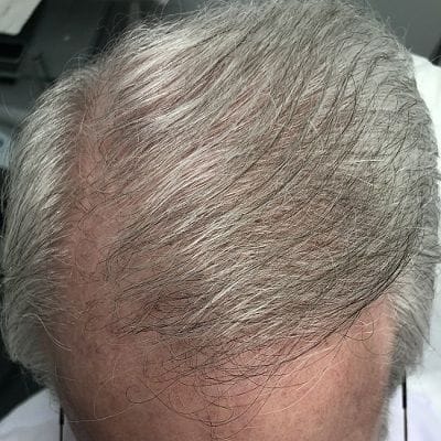 PRP Treatment For White Hair