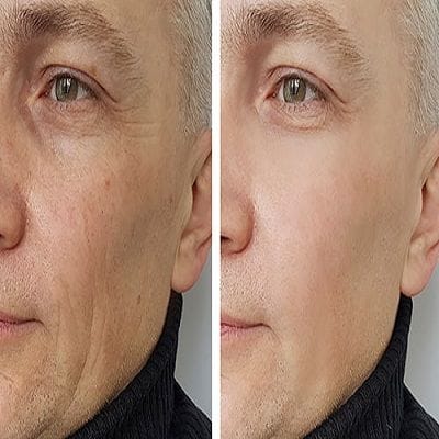 PRP treatment for face in Dubai