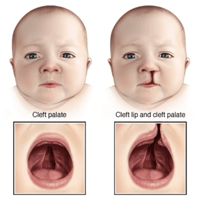 Palate Repair Surgery in Dubai