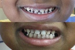 Pediatric Dentist 4 Pediatric Dentistry Before & After