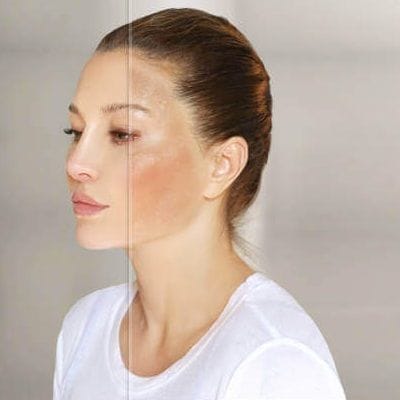 Peel To Perfection Dermamelans Elegance In Skincare