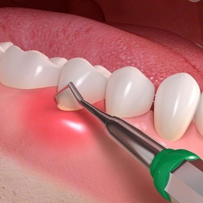 Periodontal Treatment Cost in Dubai