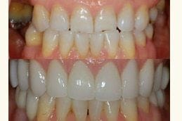 Periodontics & Gum Disease 6 Periodontics & Gum Disease Treatment Dubai