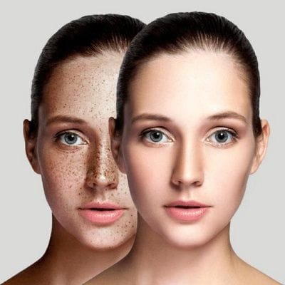 Pigmentation Treatment for Oily Skin Uae