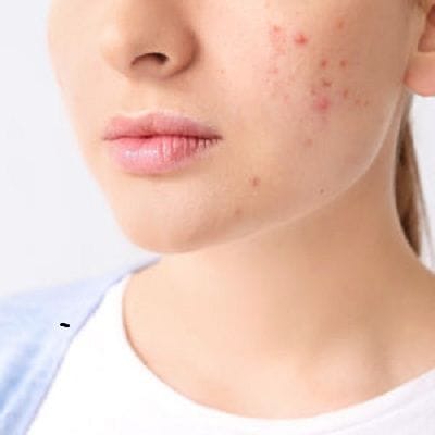 Pimples On Cheeks Treatment in Dubai