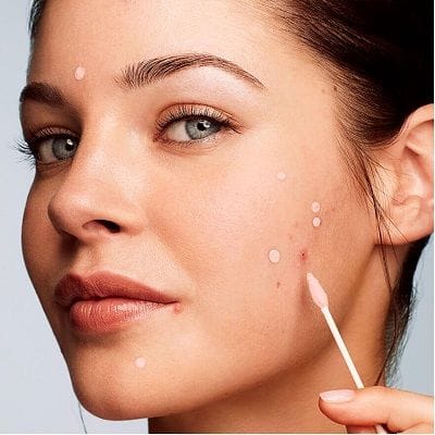 Pimples Treatment Cost in Dubai, Abu Dhabi and Sharjah 1 Pimples Treatment Cost in Dubai & Abu Dhabi