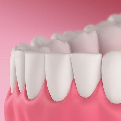 Pink Gums With Laser in Dubai & Abu Dhabi | Enfield Clinic