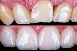 Porcelain Dental Veneers Dubai Porcelain Dental Veneers Dubai