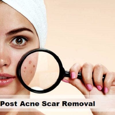 Post Acne Scars Removal Cost in Dubai